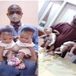 Doctors successfully separate conjoined twins in Kwara