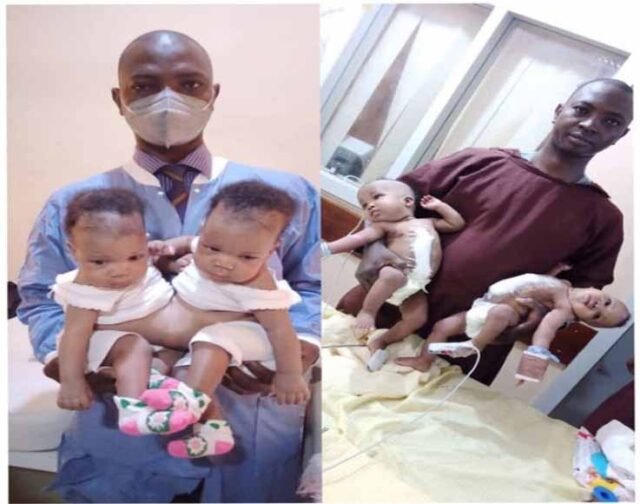 Doctors successfully separate conjoined twins in Kwara