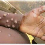 U.S. confirms case of monkeypox ‘imported’ from Nigeria