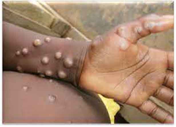 U.S. confirms case of monkeypox ‘imported’ from Nigeria