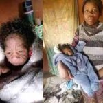 20-year-old South African woman gives birth to baby with  rare condition, progeria