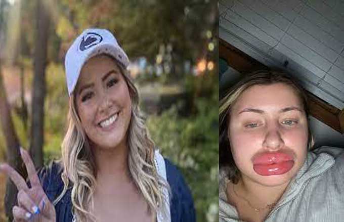 Woman's Lips Swells to eight times the normal size after Allergic reaction to fillers 