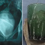 Glass tumbler found in woman’s bladder 4 years after she used it as s3x toy