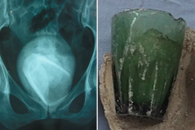 Glass tumbler found in woman’s bladder 4 years after she used it as s3x toy