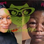 Lady left with a severely swollen face after applying a ch@mical substance to her hair