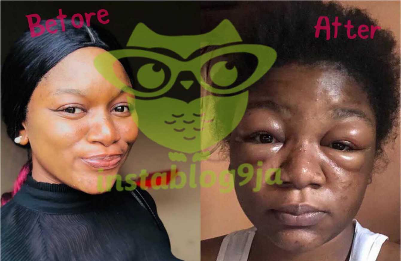 Lady left with a severely swollen face after applying a ch@mical substance to her hair